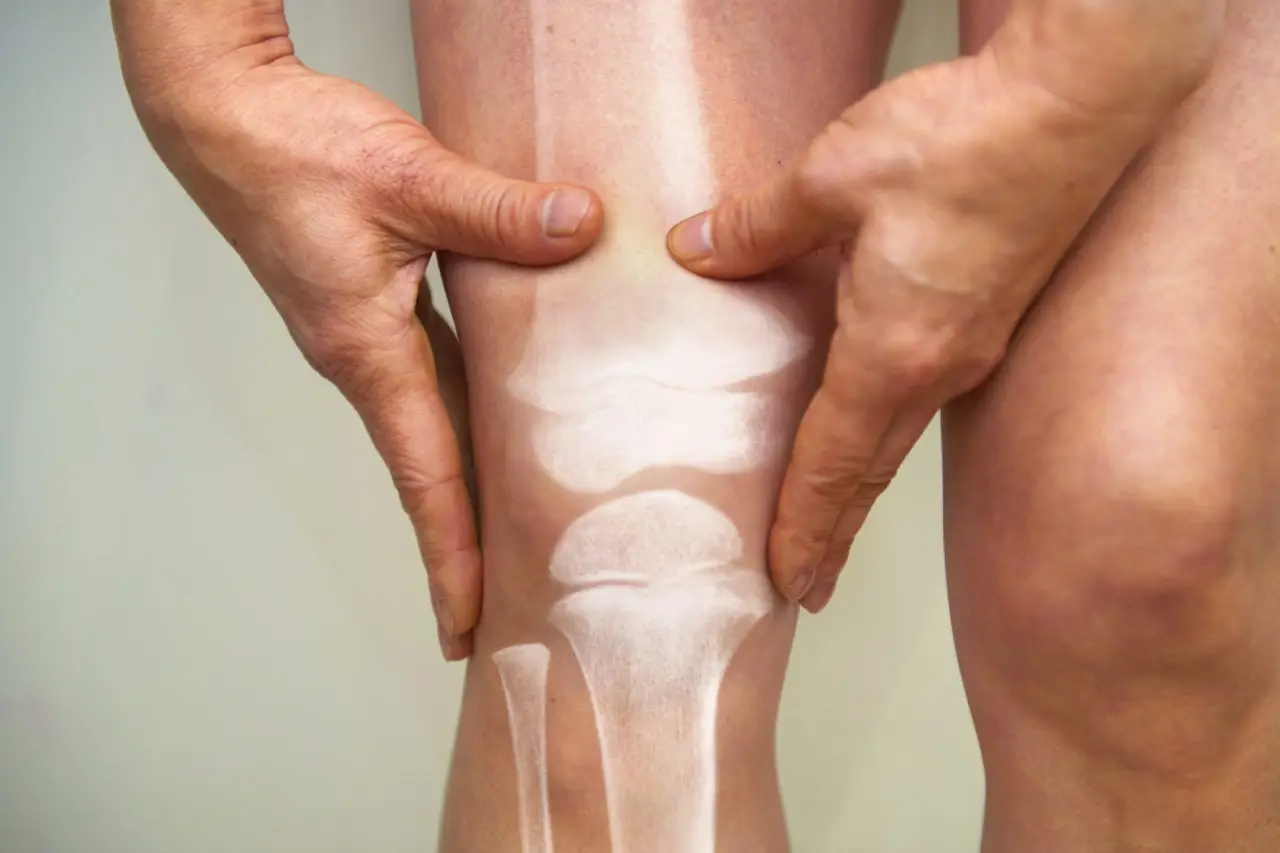 Come prevenire l’osteoporosi con l’alimentazione corretta Immagine selezionata